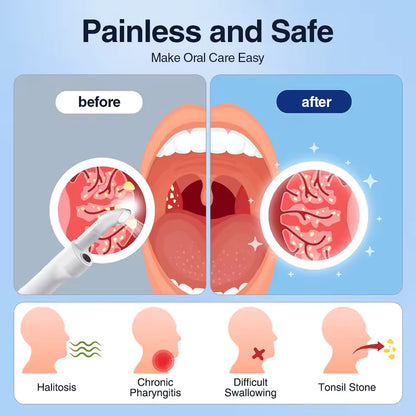 Electric Tonsil Stone Remover with Camera
