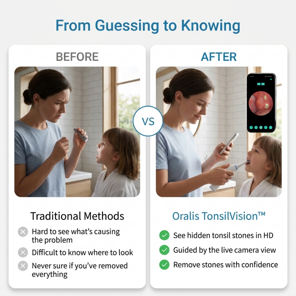 An infographic comparison graphic titled 'From Guessing to Knowing' showing a side-by-side 'Before' and 'After' demonstration of a TonsilVision stone remover tool being used by a woman and child. The left 'Before' column lists disadvantages of traditional methods, while the right 'After' column lists benefits of the 'Oralis TonsilVision' device, including high-definition live camera view and guided stone removal.