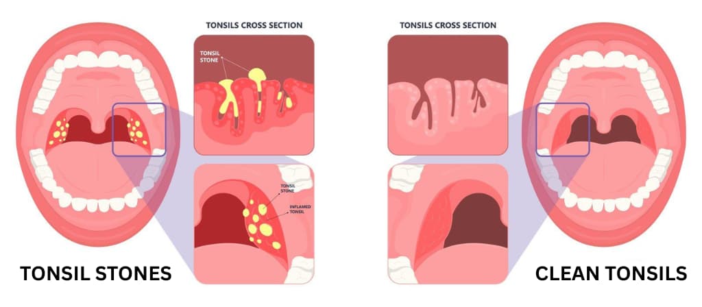 Illustration showing tonsil stones and clean tonsils with cross-sectional views.