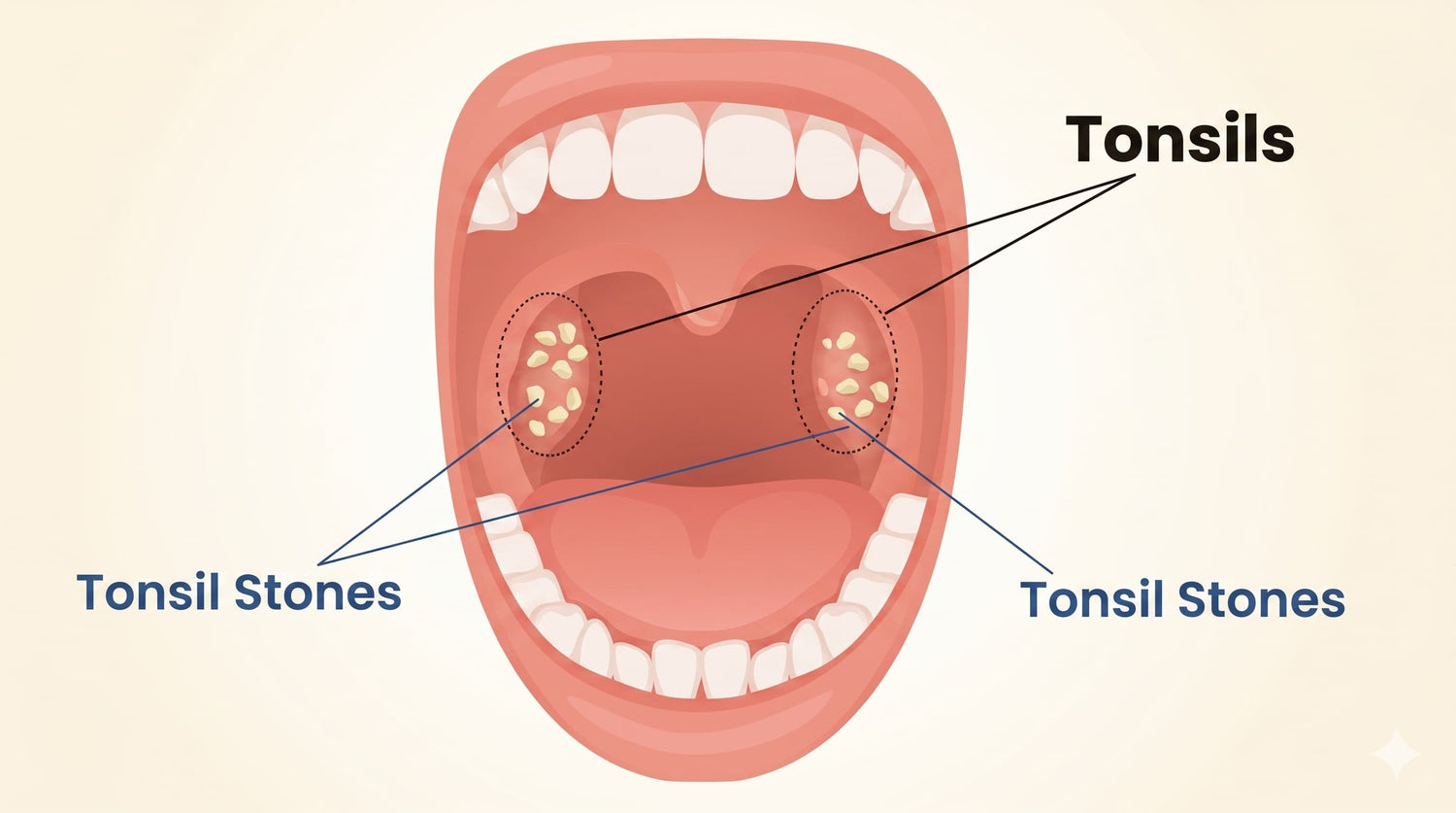 Diagram of tonsils and tonsil stones in a mouth